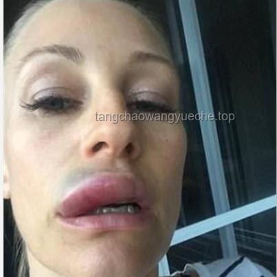 女演员整容风险警示与自然美保持策略